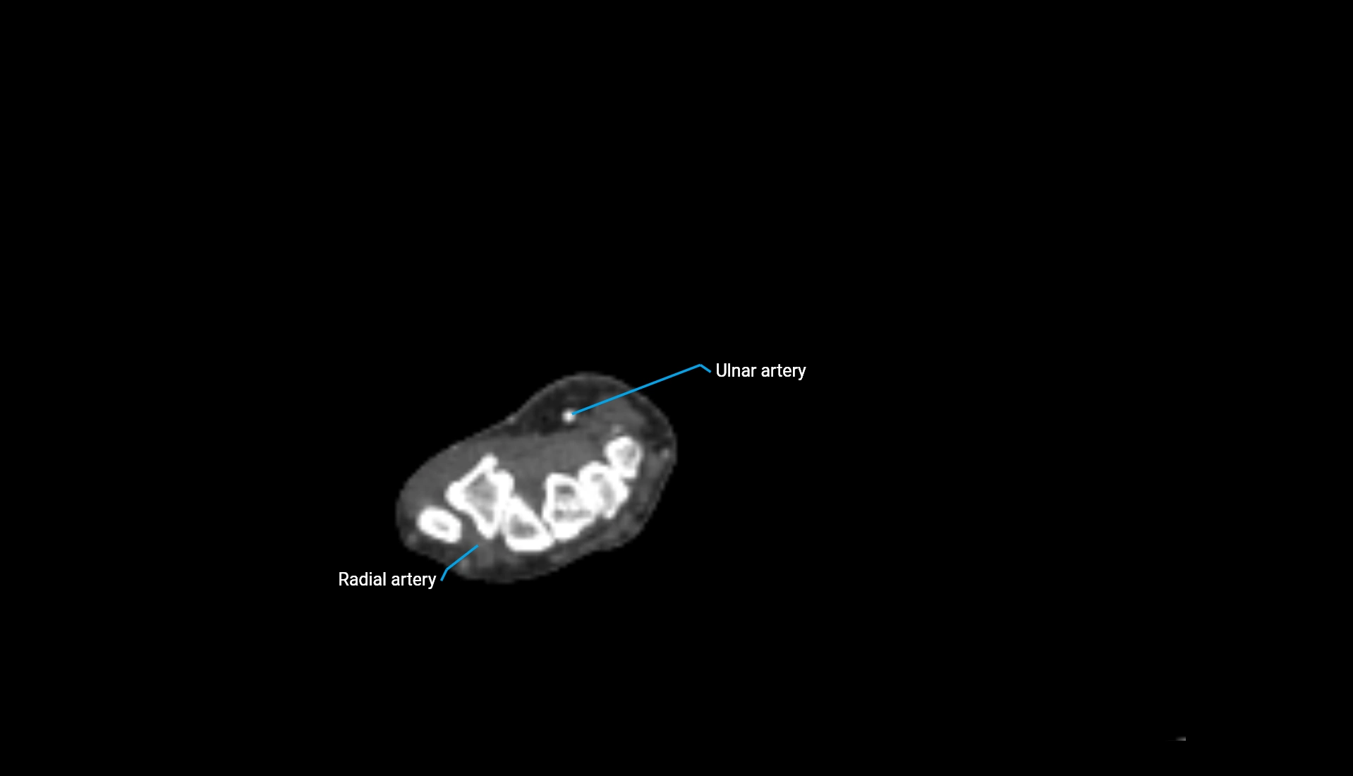 CTA upper limb axial cross sectional anatomy labelled image 73 (2).webp